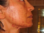 IPL burn marks cheek